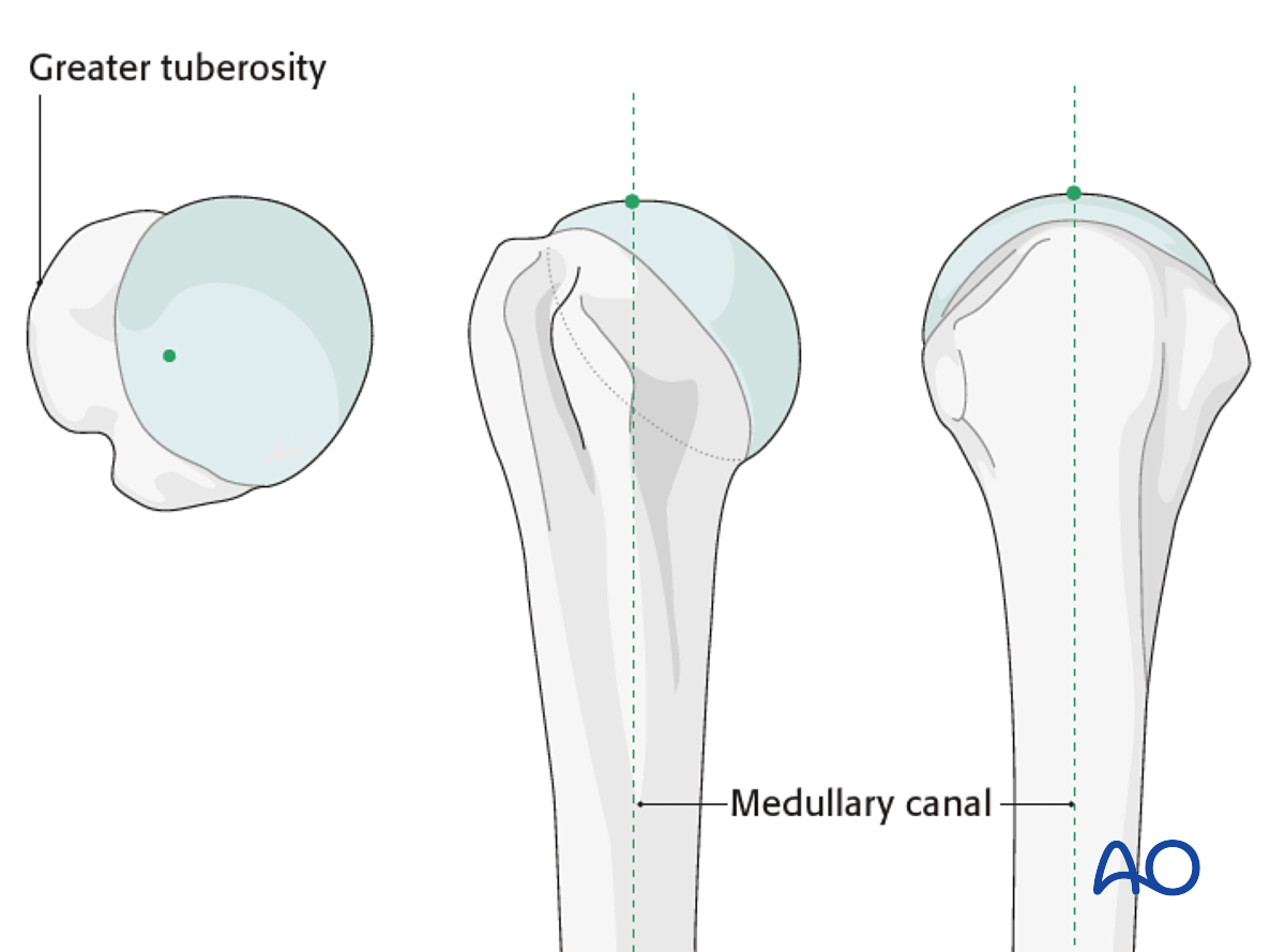 Elastic nailing in humeral fractures (retrograde technique) | Download  Scientific Diagram